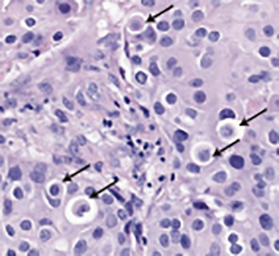 Figure 1: A human breast cancer sample stained by H&E; arrow heads indicate cell-in-cell structures.